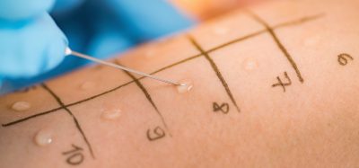 allergy test